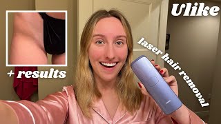 Ulike LASER HAIR REMOVAL Review unboxing and 3 weeks using it [upl. by Sylvester]