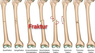 Frakturen Erkrankungen des Bewegungsapparates [upl. by Kleper122]