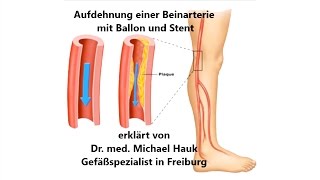 Aufdehnung einer verengten Beinarterie bei Schaufensterkrankheit pAVK [upl. by Nifares]