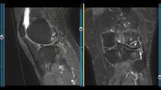 Ill defined bone lesion in tibia [upl. by Terti]