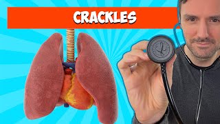 Fine and Coarse Crackles Lung Sounds For Beginners 🔥🔥🔥 [upl. by Maurilia]