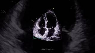 Closure device in situ 🩵🫀 cardiology amplatzer cardiologia echocardiogram [upl. by Onig]