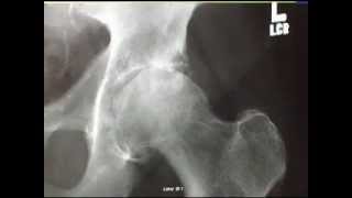 Diagnosing an Arthritic Hip Joint [upl. by Dachia]