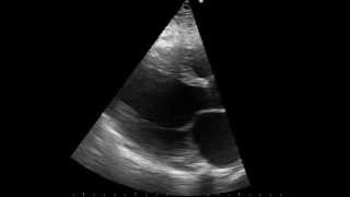 parasternal long axis echo of a patient with dilated cardiomyopathy [upl. by Annaek]