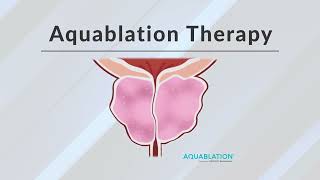 What is Aquablation Therapy [upl. by Clemmy783]