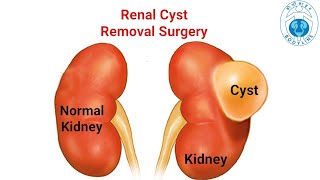 Laparoscopic Renal Cyst Deroofing Bodylinehospitals by drutsavshahurologist done successfully [upl. by Belden]