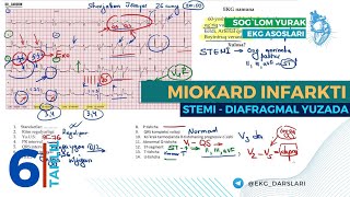 EKG Tahlili06  Miokard Infarkti  EKG Namunasi [upl. by Akenom]