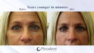 Plexaderm Before amp After Transformation [upl. by Arimay]