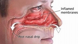 How to Cure Postnasal Drip Removing Allergens from Your Environment and Using Unverified Natural [upl. by Aitnauq]