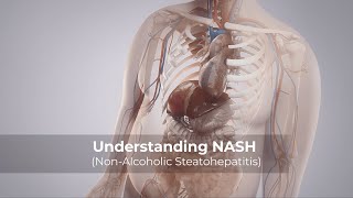 Understanding NASH NonAlcoholic Steatohepatitis [upl. by Baillieu]