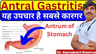 Antral Gastritis Causes Symptoms and Effective Treatments drramakantsharma7 [upl. by Odidnac]