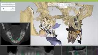 Implantes dentales con protocolo 3D completo [upl. by Severen65]