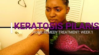 HOW TO REMOVE KERATOSIS PILARIS Week 1 Home Remedy Treatment [upl. by Eninahs99]