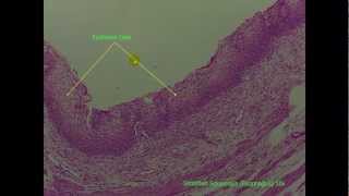 Stratified Epithelial 2 of 2 [upl. by Caesar]