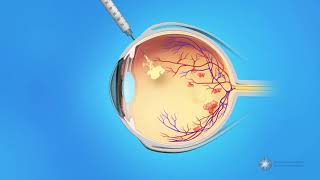 Eye Injections for Central Retinal Vein Occlusion CRVO [upl. by Lleraj]