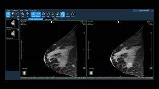 Koning Clinical Case Review Invasive Lobular Carcinoma [upl. by Barbie]