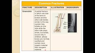 Common Fractures [upl. by Rosemare]