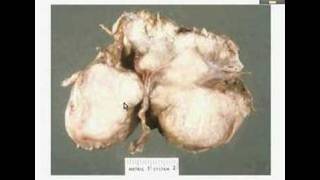 HistopathologyBrain Meningioma [upl. by Gram]