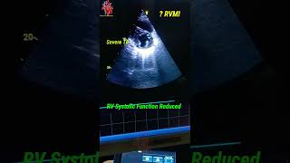 ECHO Rv systolic Function Reduced  Severe TR  RVMI ytshorts heartknowledge severe tr [upl. by Hunfredo885]