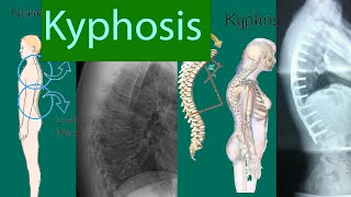 Kyphosis Slouching posture Kyphosis types symptoms and treatment [upl. by Carmelle936]