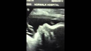 32 Weeks Pregnant Ultrasound Compilation [upl. by Nosilla793]