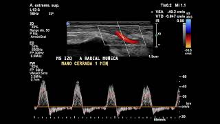 Ecografía Doppler de miembro superior izquierdo [upl. by Atteuqahs]