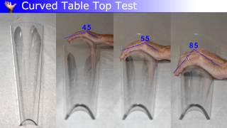 Measurement of Dupuytren Disease [upl. by Levine486]