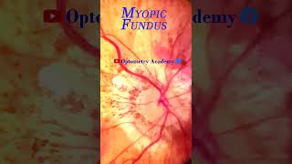 Myopic degeneration  Smartphone Fundus Videography  Fundus Photography  Short Video 63 [upl. by Edmund]