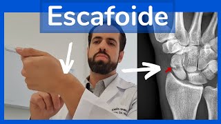 Tratamento do Escafoide  Gesso ou Cirurgia [upl. by Nyloc]