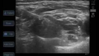 ultrasound guided supraclavicular brachial plexus block [upl. by Ppik]