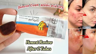 How To Use Azelaic Acid  Benefits  Best Products In Pakistan  The Ordinary VS Skinoren Cream [upl. by Ecnerol416]