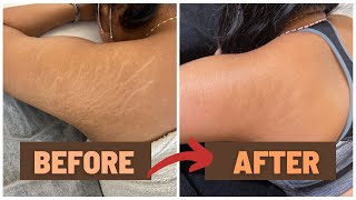 HOW I GOT RID OF MY STRETCH MARKS  NUE CONCEAL NUE CLEAR [upl. by Nosyerg472]