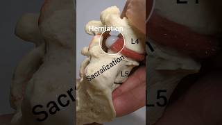 Disc Herniation Model with Lumbosacral Transitional Vertebrae [upl. by Anawaj208]