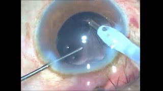 Epinucleus and Cortex Aspiration with coaxial IA Soosan Jacob with audio 5 min [upl. by Nojed77]