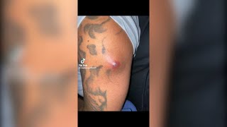 Popping huge blackheads and Pimple Popping  Best Pimple Popping Videos 158 [upl. by Pascale]