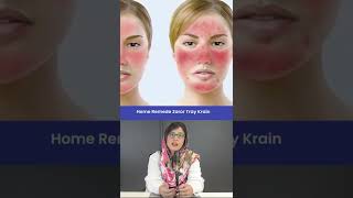 Doctor tells home remedies to Treat Rosacea  shorts skincare disease rosacea [upl. by Ynotna]