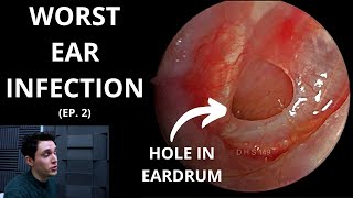 The Worst Ear Infection Episode 2 [upl. by Dranel880]