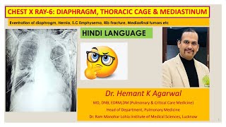 Radiology Chest X Ray6 HINDI Diaphragm Chest wall and MediastinumDr Hemant K Agarwal [upl. by Mannie]