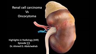 Renal Cell Carcinoma vs Oncocytoma Highlights in Radiology Episode 13 [upl. by Ardek787]