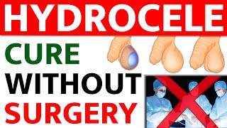 Hydrocele Cure Without Surgery  Hydrocele Causes Symptoms and Treatment  Bharat Homeopathy [upl. by Etnuad724]