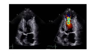 How to Assess the Level of Obstruction with Echocardiography in Patients with HCM [upl. by Hosea]