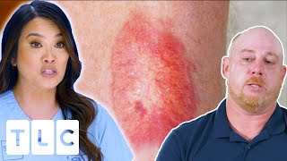 Unknown Red Patch On Man’s Leg Gets A Diagnosis After 12 Years  Dr Pimple Popper This Is Zit [upl. by Ecinnaj]