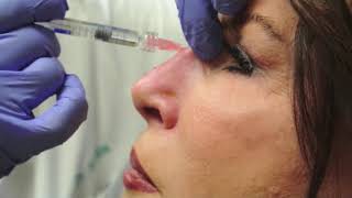 Nonsurgical Rhinoplasty [upl. by Van]