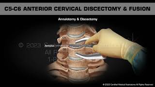 C5C6 Anterior Cervical Discectomy amp Fusion [upl. by Eceela]