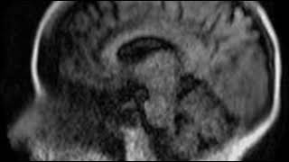 Hyperfine Clinical Scan Example T1 Weighted [upl. by Dearden5]