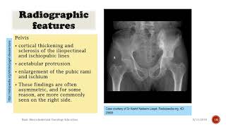 1222 Skull in Pagets Disease  Xray Reading  Dr Vaidya [upl. by Ettevroc]