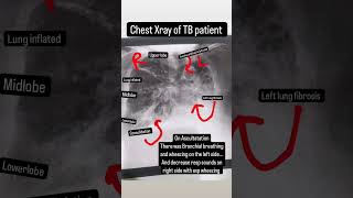 Chest xray of TB of lungs xray tb [upl. by Birmingham]