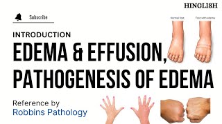 Edema Oedema  Part 1  Effusion  Hemodynamic Disorders Pathology  KTC MBBS [upl. by Eeliak]