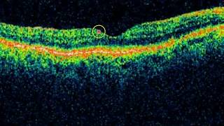 Mastering OCT Interpretation with Dr Mark Friedberg [upl. by Kaye]