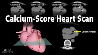 Calcium Score Heart Scan Animation [upl. by Arahsak146]